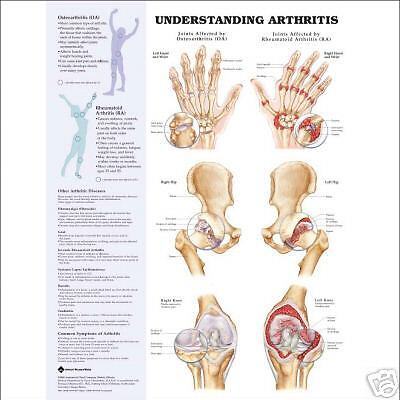 Understanding Arthritis, Anatomical Chart/Charts/Model  